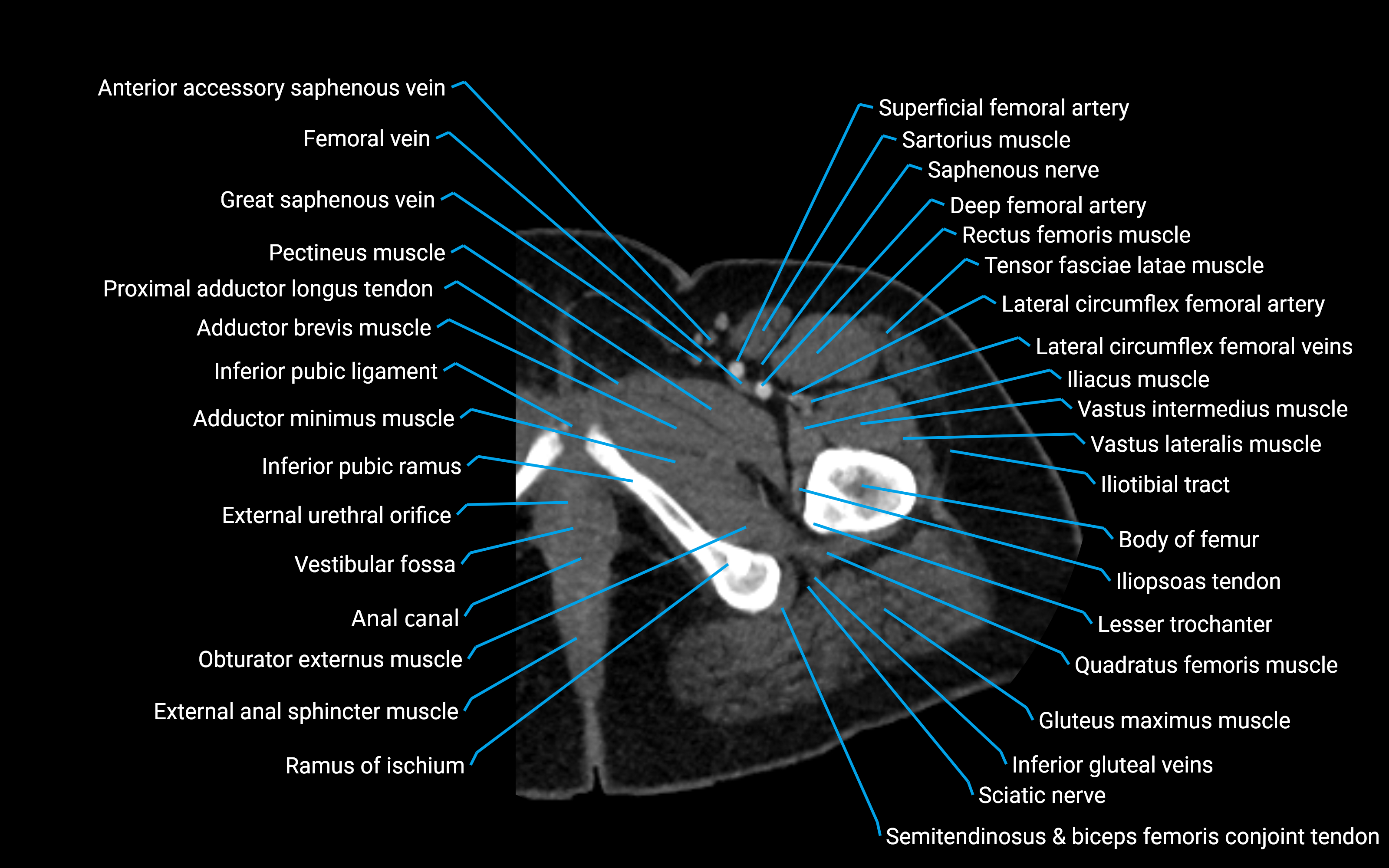 CT Hip axial cross sectional anatomy labelled image 16 (2).png